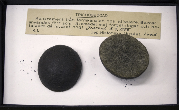 Trichobezoar